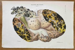 Liver Disease - Lithograph By Ottavio Muzzi - 1843