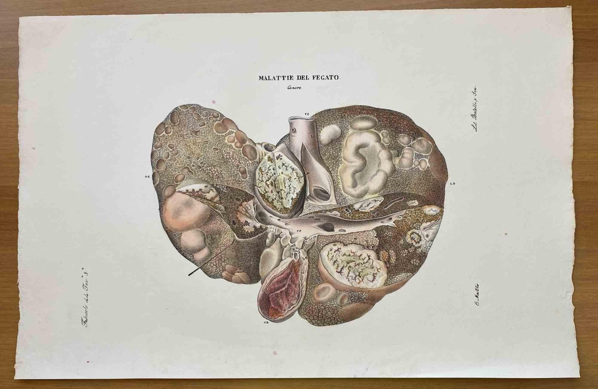 Liver Disease is a lithograph hand colored by Ottavio Muzzi for the edition of Antoine Chazal, Human Anatomy, Printers Batelli and Ridolfi, 1843.

The work belongs to the Atlante generale della anatomia patologica del corpo umano by Jean