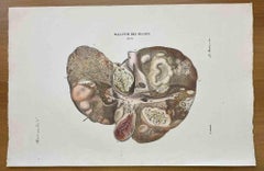 Liver Disease - Lithograph By Ottavio Muzzi - 1843
