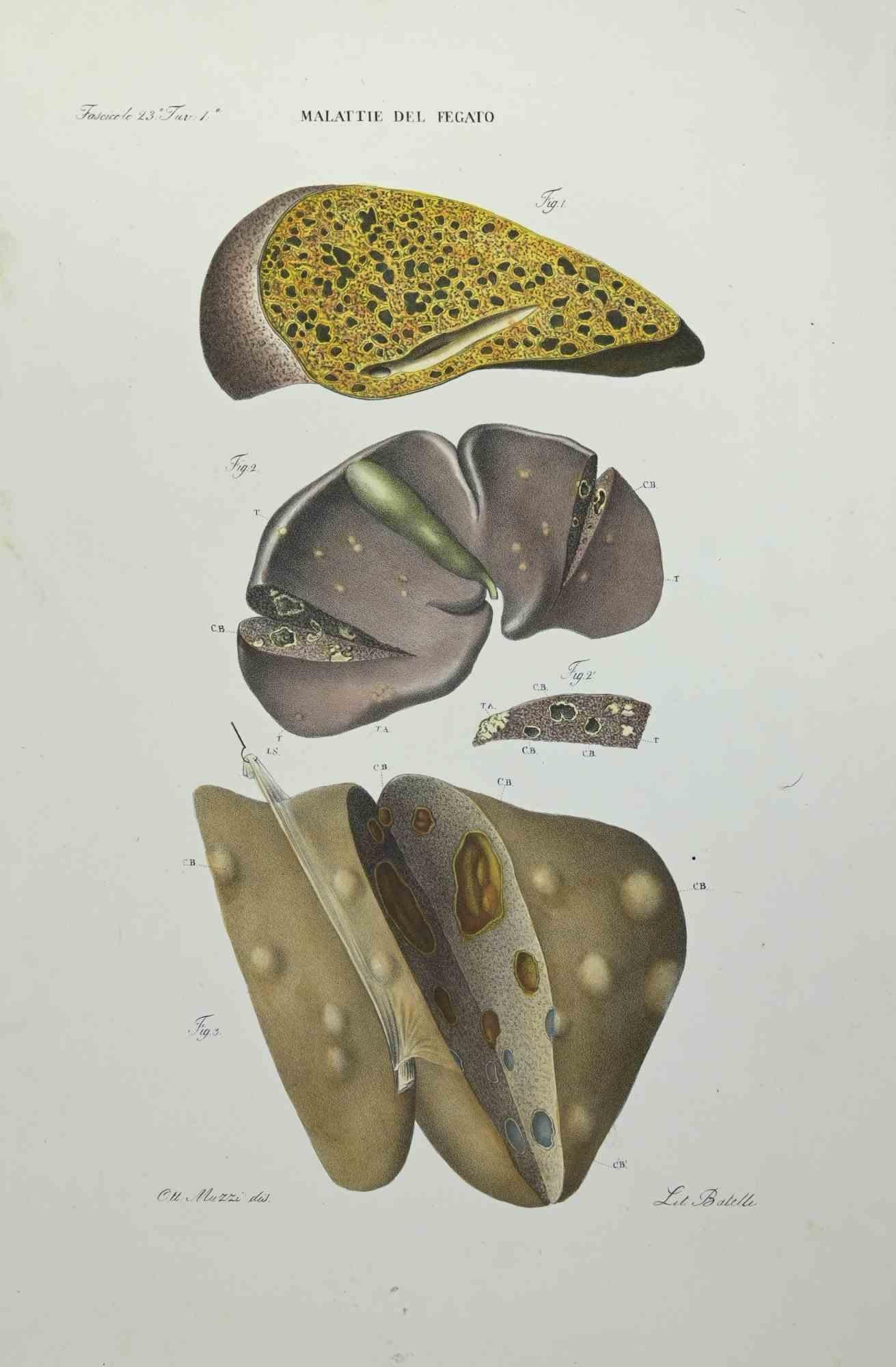 Liver Disease - Lithograph By Ottavio Muzzi - 1843