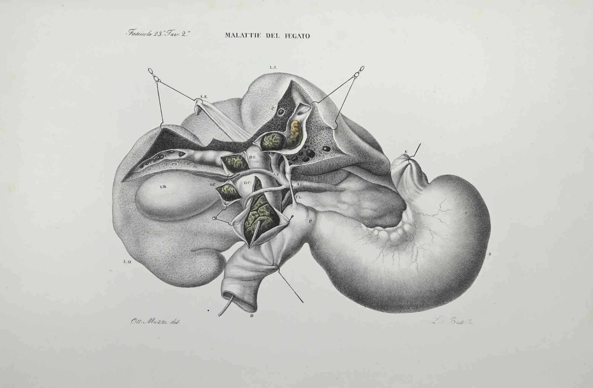 Liver Disease - Lithograph By Ottavio Muzzi - 1843