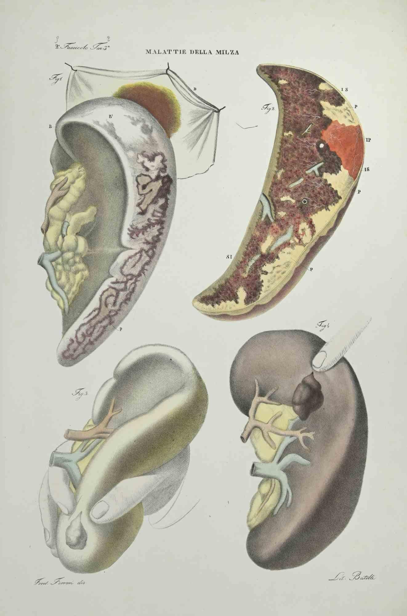 Liver Diseases - Lithograph By Ottavio Muzzi - 1843