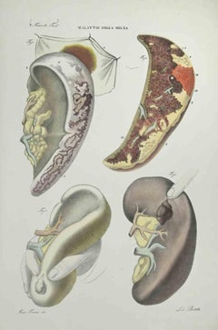 Antique Liver Diseases - Lithograph By Ottavio Muzzi - 1843