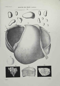 Antique Liver Diseases - Lithograph By Ottavio Muzzi - 1843