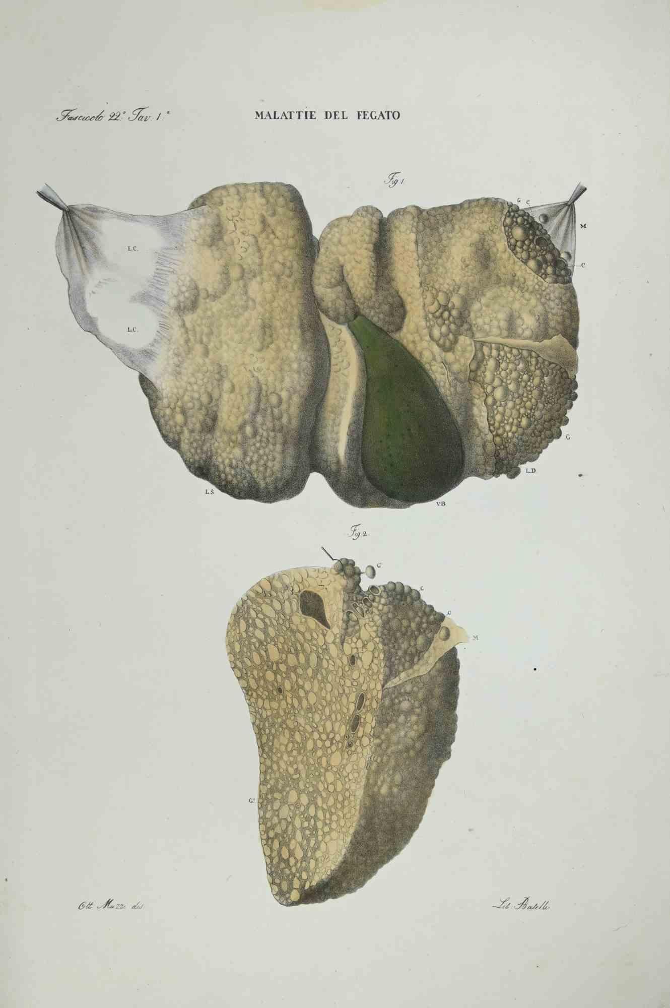 Liver Diseases is a lithograph hand colored by Ottavio Muzzi for the edition of Antoine Chazal, Human Anatomy, Printers Batelli and Ridolfi, realized in 1843.

Signed on plate on the left corner.

The artwork belongs to the "Atlante Generale della