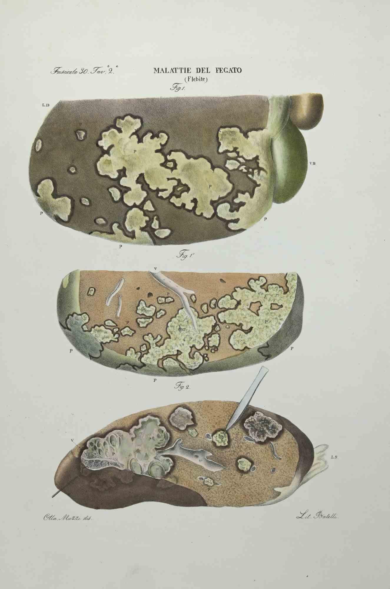 Liver Diseases is a lithograph hand colored by Ottavio Muzzi for the edition of Antoine Chazal,Human Anatomy, Printers Batelli and Ridolfi, realized in 1843.
Signed on plate on the lower left margin. 

The artwork belongs to the "Atlante Generale