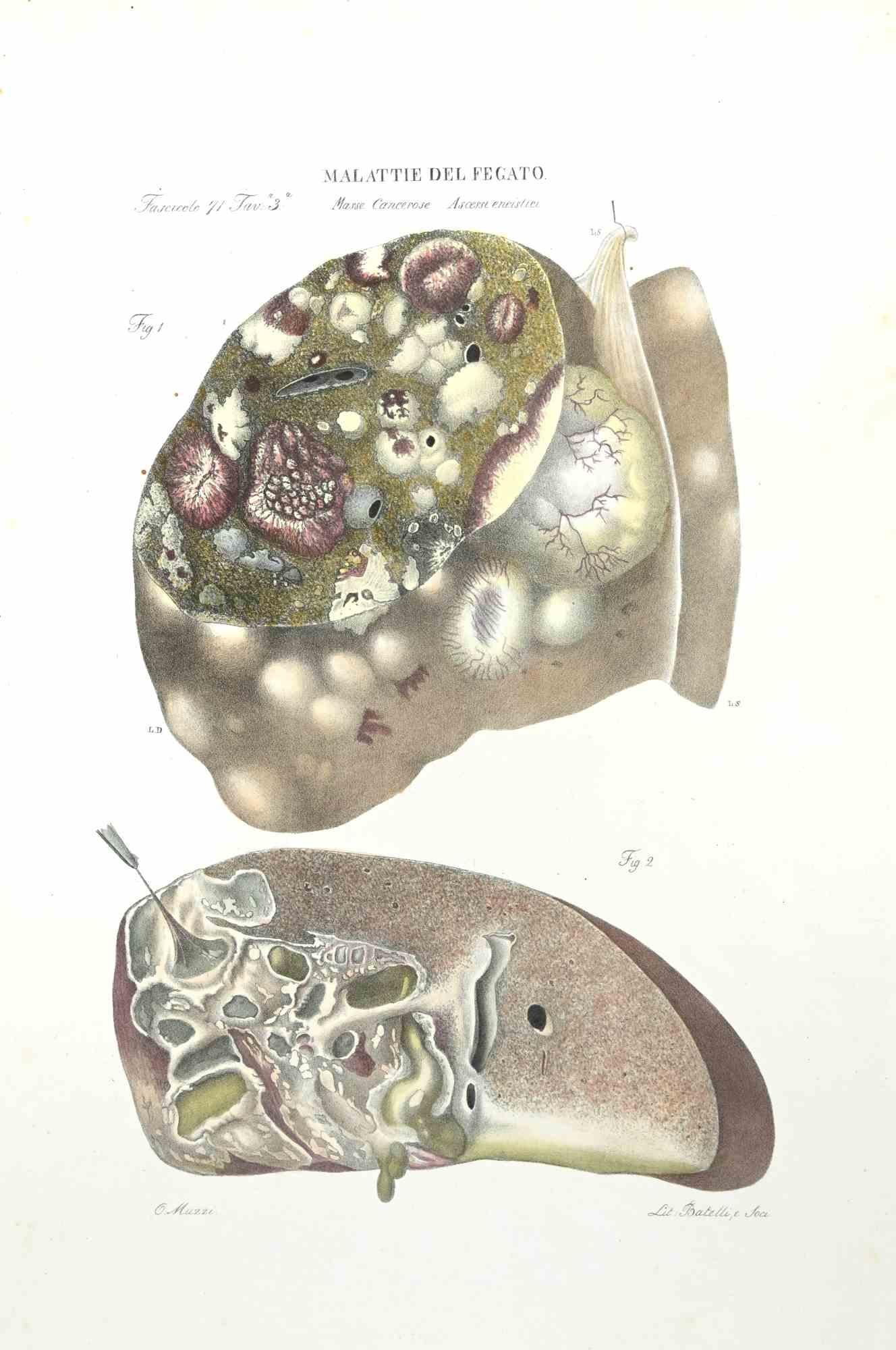 Liver Diseases - Lithograph By Ottavio Muzzi - 1843