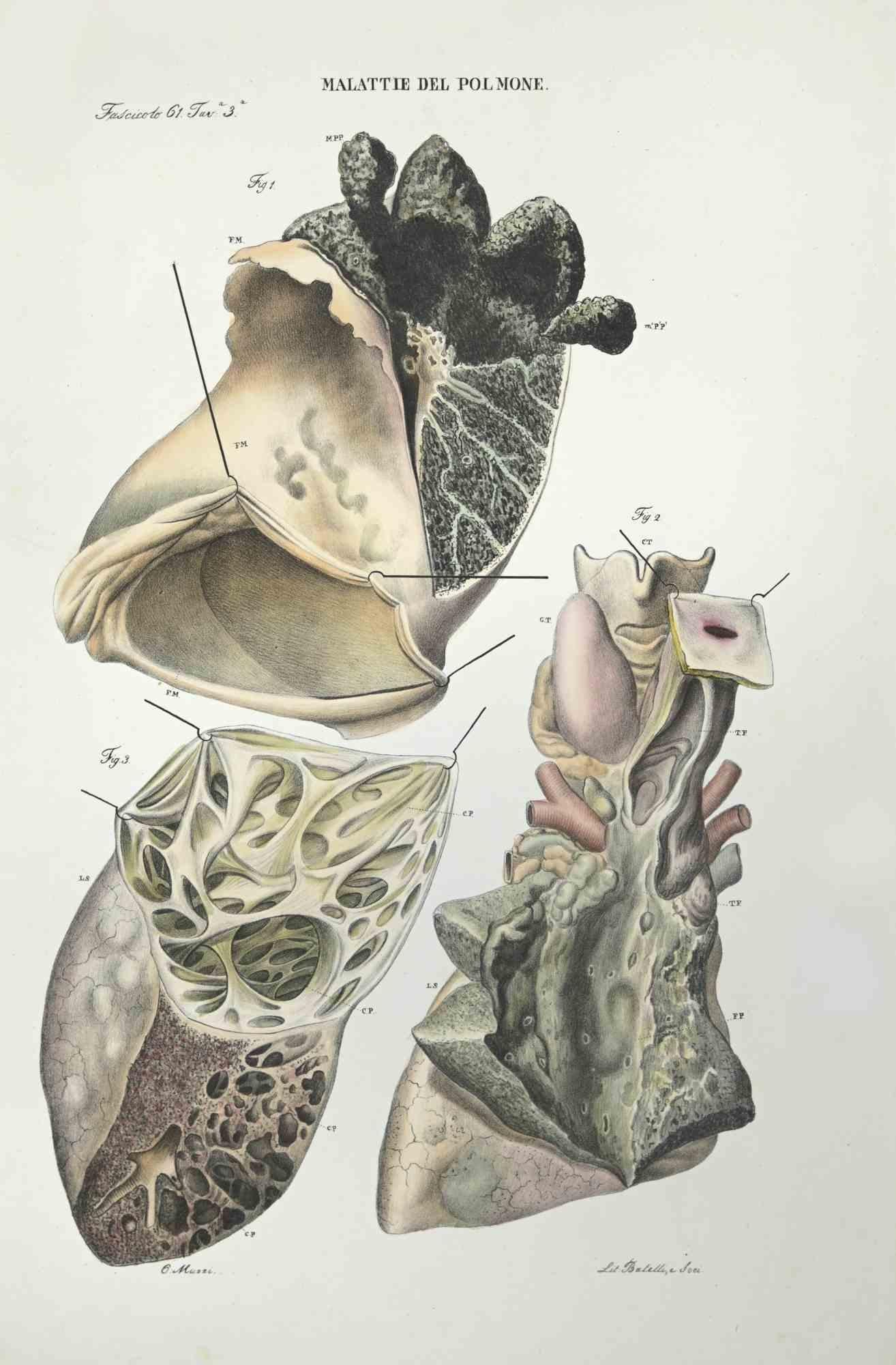 Lung Diseases ist eine handkolorierte Lithographie von Ottavio Muzzi für die Ausgabe von Antoine Chazal, Human Anatomy, Printers Batelli and Ridolfi, 1843.

Das Werk gehört zum Atlante generale della anatomia patologica del corpo umano von Jean