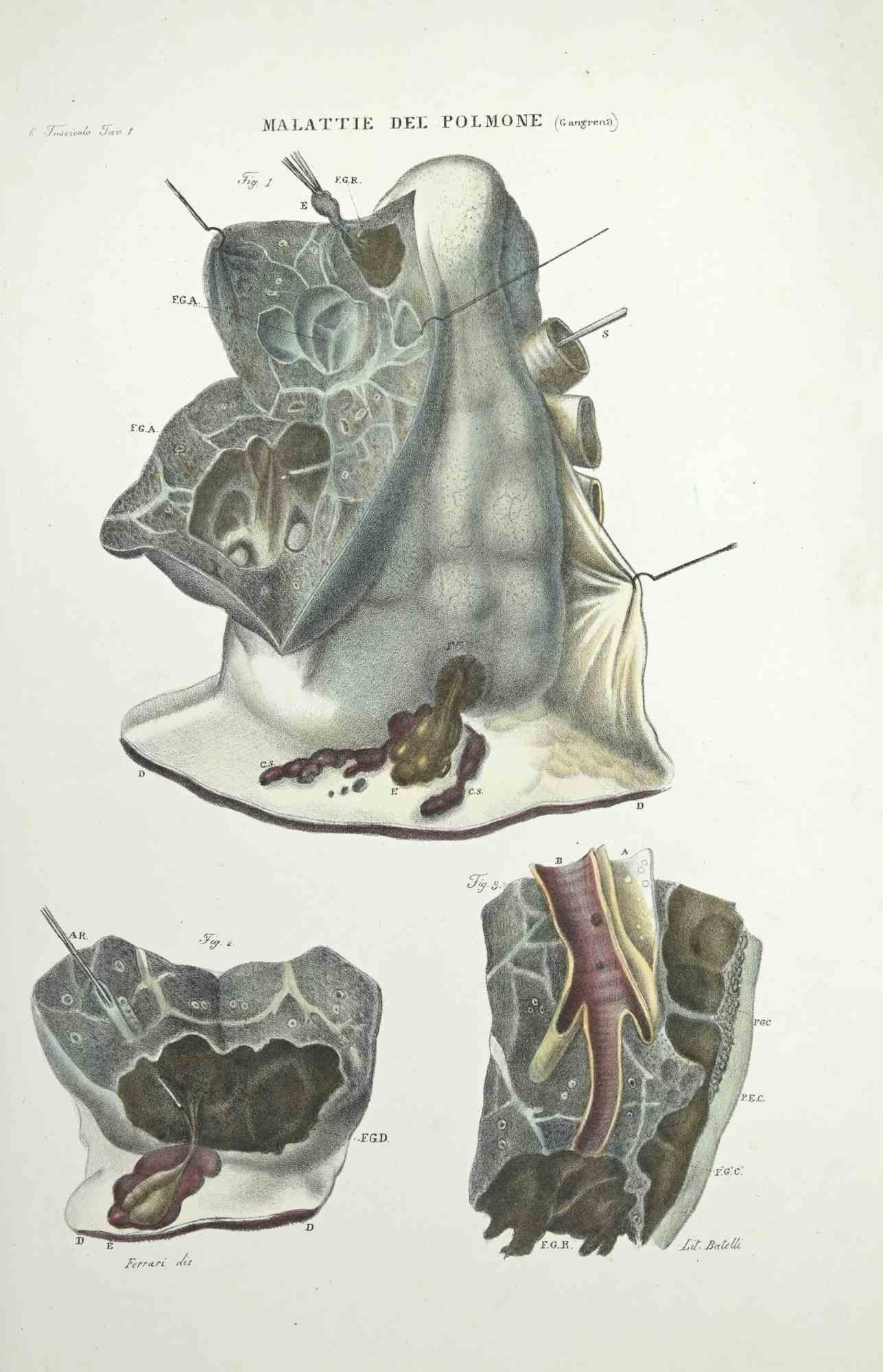Lung Diseases is a lithograph hand colored by Ottavio Muzzi for the edition of Antoine Chazal, Human Anatomy, Printers Batelli and Ridolfi, 1843.

The work belongs to the Atlante generale della anatomia patologica del corpo umano by Jean