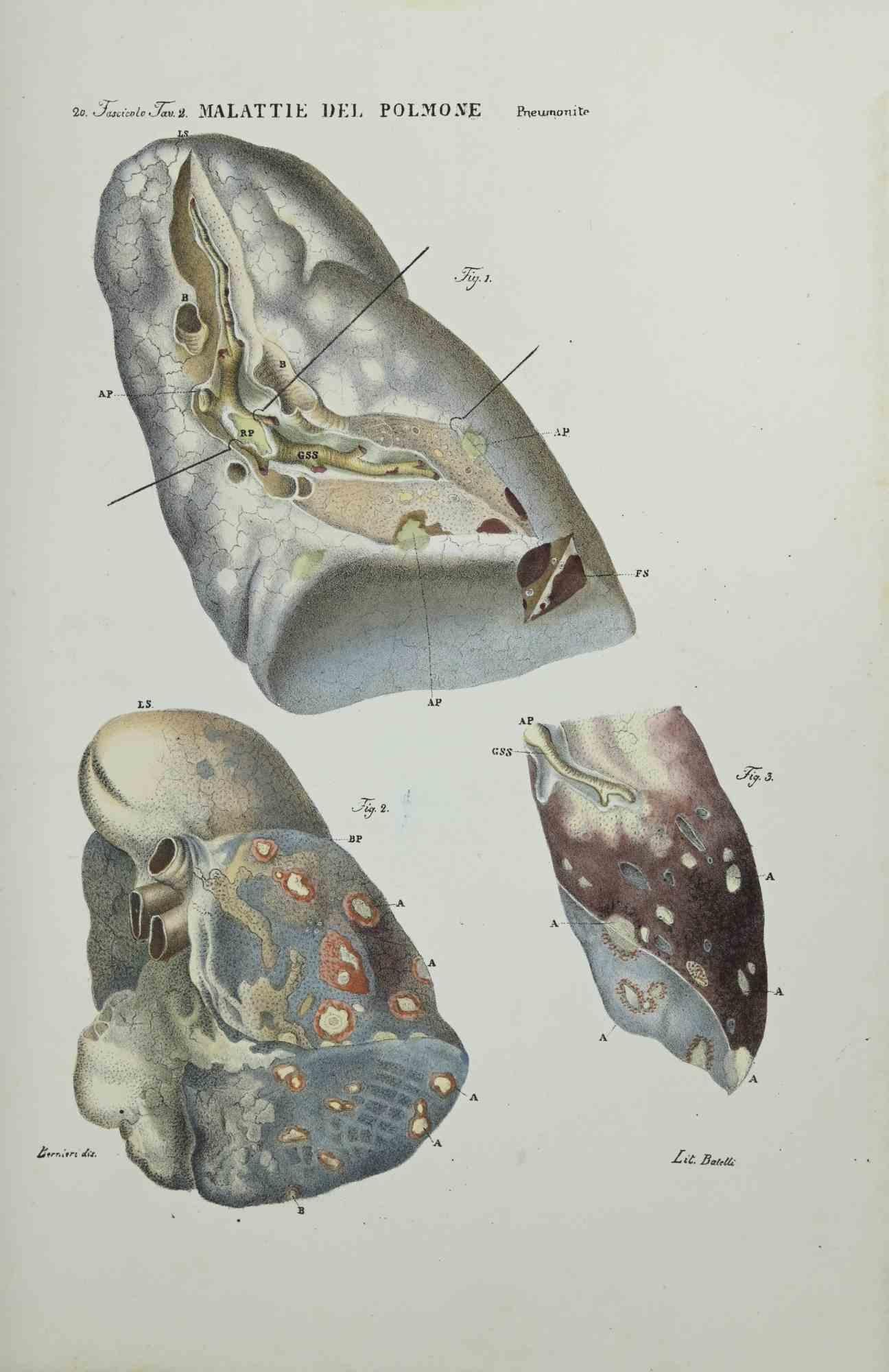 Lung Diseases is a lithograph hand colored by Ottavio Muzzi for the edition of Antoine Chazal, Human Anatomy, Printers Batelli and Ridolfi, 1843.

The work belongs to the Atlante generale della anatomia patologica del corpo umano by Jean