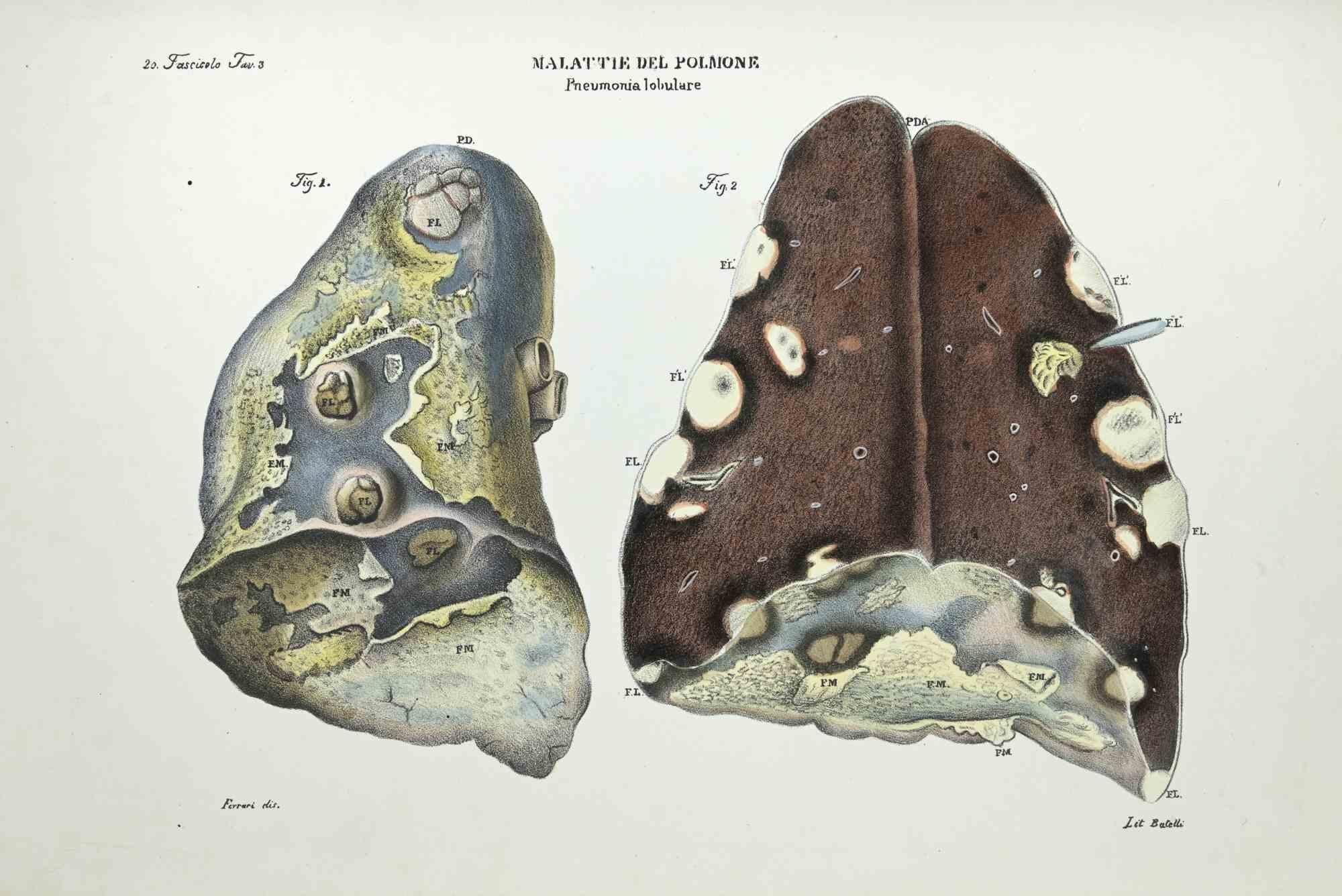 Lithographie sur les maladies de la Lung par Ottavio Muzzi - 1843