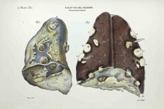 Enfermedades pulmonares - Litografía de Ottavio Muzzi - 1843