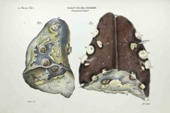 Lung Diseases - Lithograph By Ottavio Muzzi - 1843