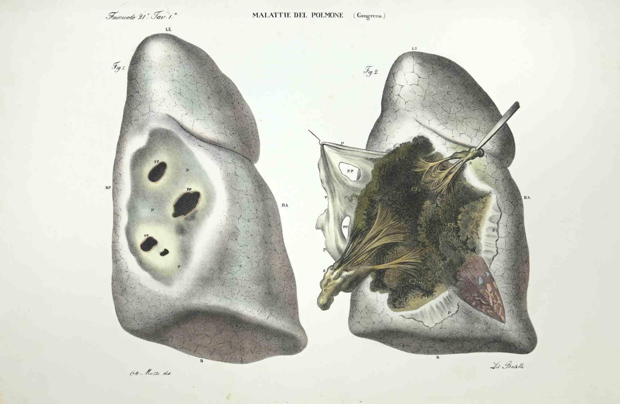 Lung Diseases is a lithograph hand colored by Ottavio Muzzi for the edition of Antoine Chazal, Human Anatomy, Printers Batelli and Ridolfi, realized in 1843.

Signed on plate on the left corner.

The artwork belongs to the "Atlante Generale della