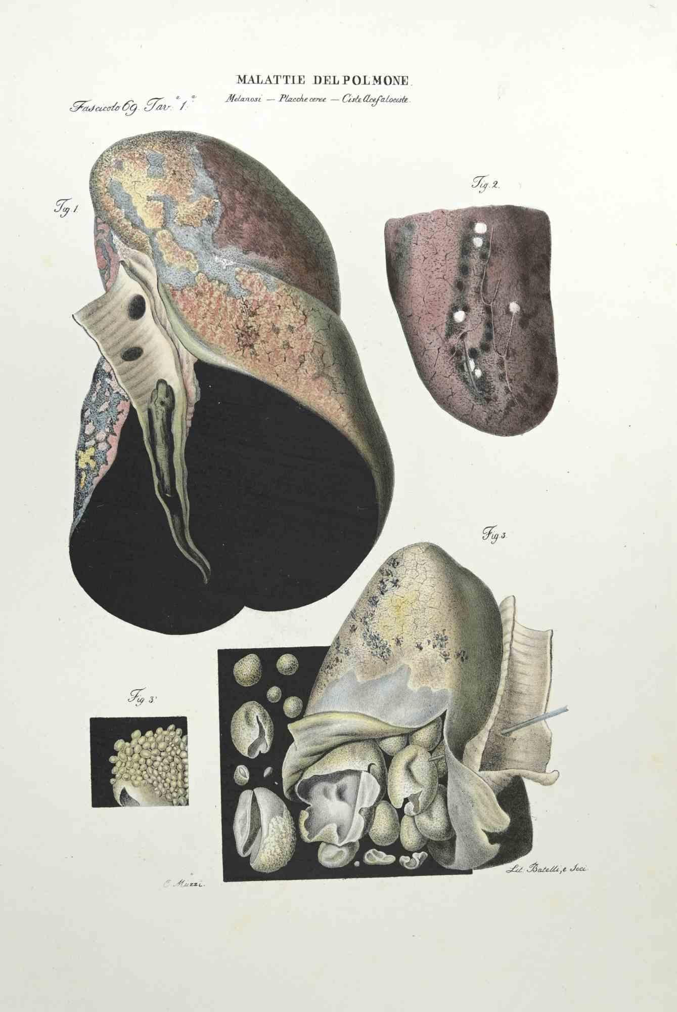 Lung Diseases is a lithograph hand colored by Ottavio Muzzi for the edition of Antoine Chazal,Human Anatomy, Printers Batelli and Ridolfi, realized in 1843.

Signed on plate on the lower left margin.

The artwork belongs to the "Atlante Generale