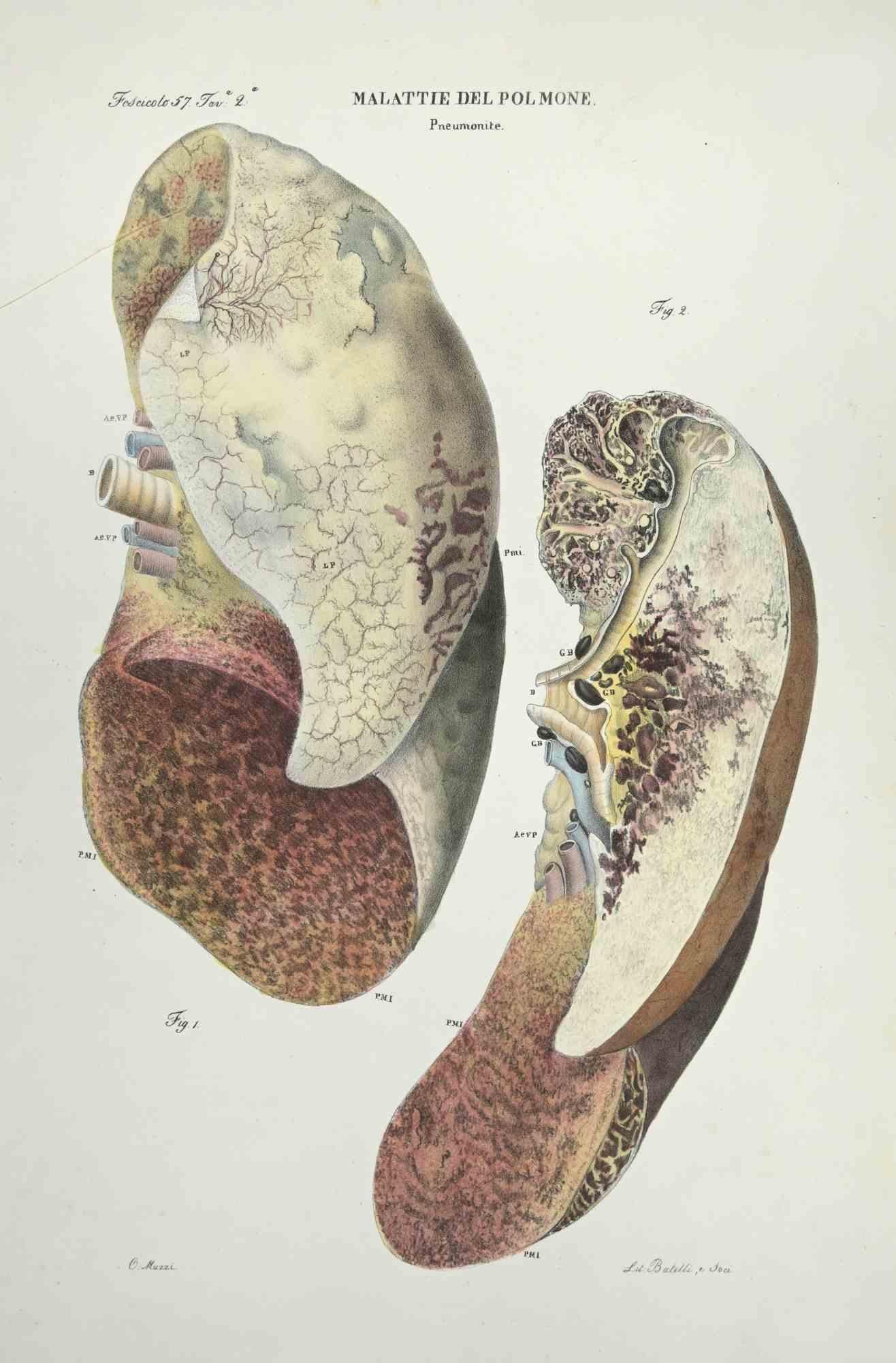 Lung Diseases is a lithograph hand colored by Ottavio Muzzi for the edition of Antoine Chazal,Human Anatomy, Printers Batelli and Ridolfi, realized in 1843.

Signed on plate on the lower left margin.

The artwork belongs to the "Atlante Generale