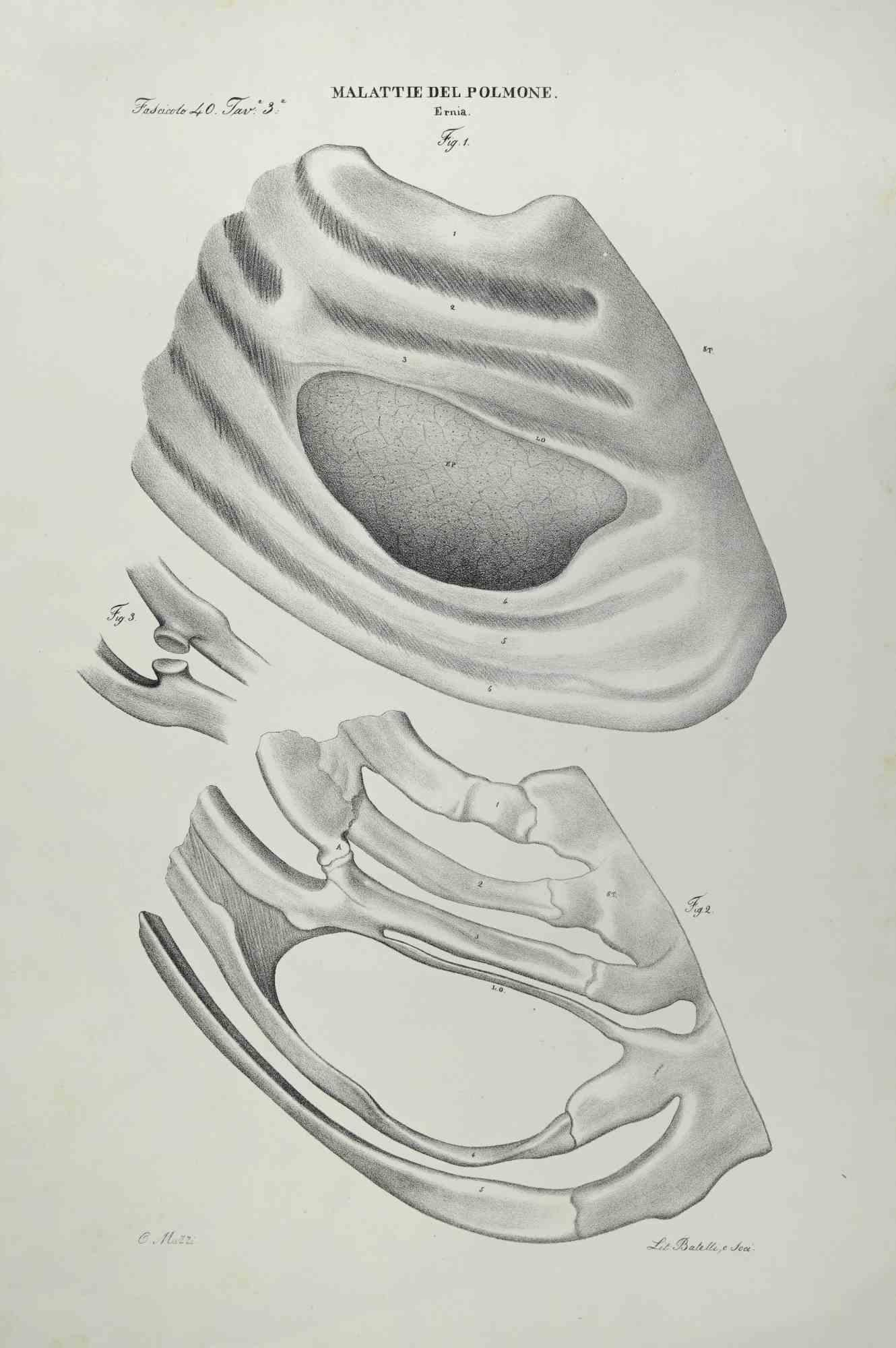 Maladies pulmonaires est une lithographie coloriée à la main par Ottavio Muzzi pour l'édition d'Antoine Chazal, Anatomie humaine, Imprimeurs Batelli et Ridolfi, réalisée en 1843.

Signé sur la plaque dans la marge inférieure gauche.