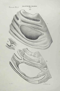 Lithographie sur les maladies de la Lung par Ottavio Muzzi - 1843