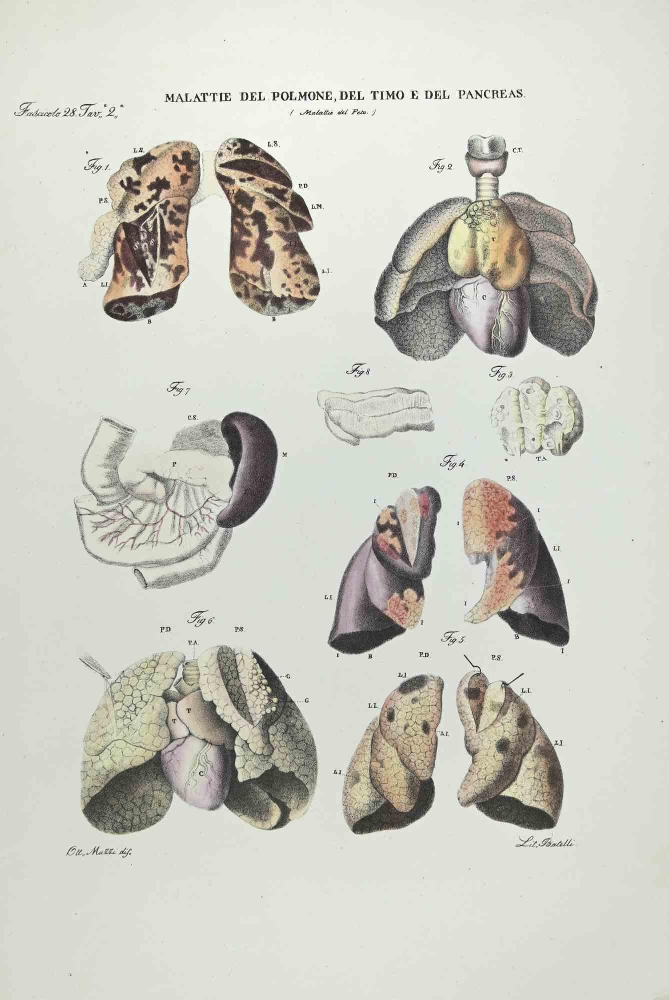 Maladies du poumon, du thymus et du pancréas est une lithographie coloriée à la main par Ottavio Muzzi pour l'édition d'Antoine Chazal, Anatomie humaine, Imprimeurs Batelli et Ridolfi, réalisée en 1843.
Signé sur la plaque dans la marge inférieure