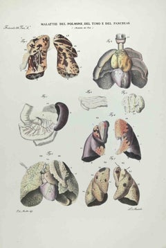  Lung, Thymus and Pancreatic Diseases - Lithograph By Ottavio Muzzi - 1843