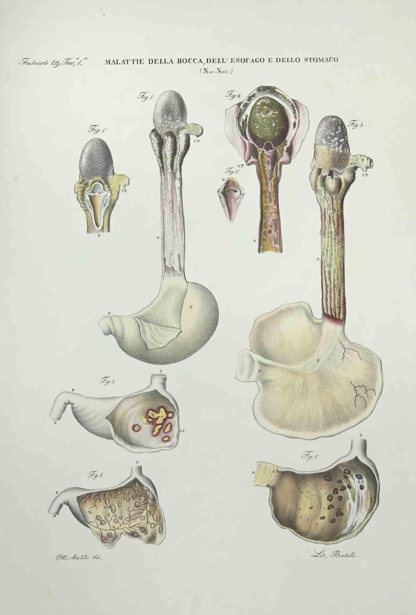 Maladies de la bouche, de l'œsophage et de l'estomac - Lithographie d'Ottavio Muzzi - 1843