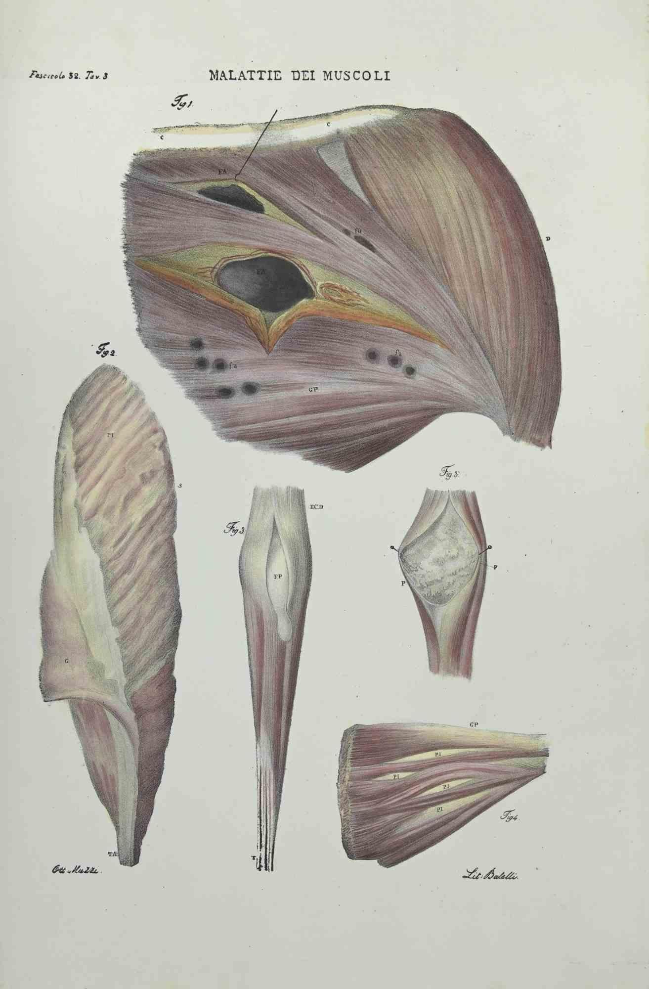 Muscles Diseases is a lithograph hand colored by Ottavio Muzzi for the edition of Antoine Chazal,Human Anatomy, Printers Batelli and Ridolfi, realized in 1843.
Signed on plate on the lower left margin. 