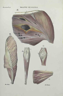 Muscles Diseases - Lithograph By Ottavio Muzzi - 1843