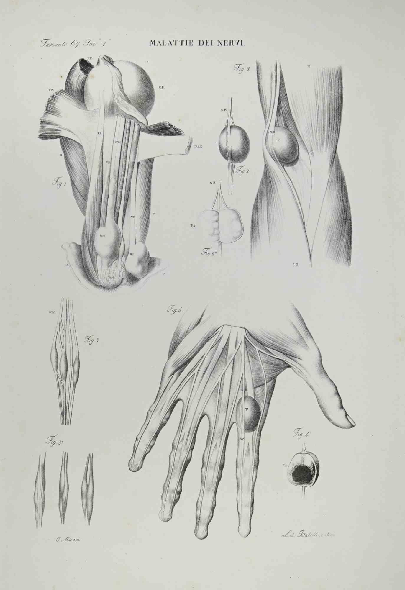Nervous Diseases is a lithograph realized by Ottavio Muzzi for the edition of Antoine Chazal, Human Anatomy, Printers Batelli and Ridolfi, 1843.

The work belongs to the Atlante generale della anatomia patologica del corpo umano by Jean CRUVEILHIER,