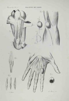 Nervouskrankheiten – Lithographie von Ottavio Muzzi – 1843