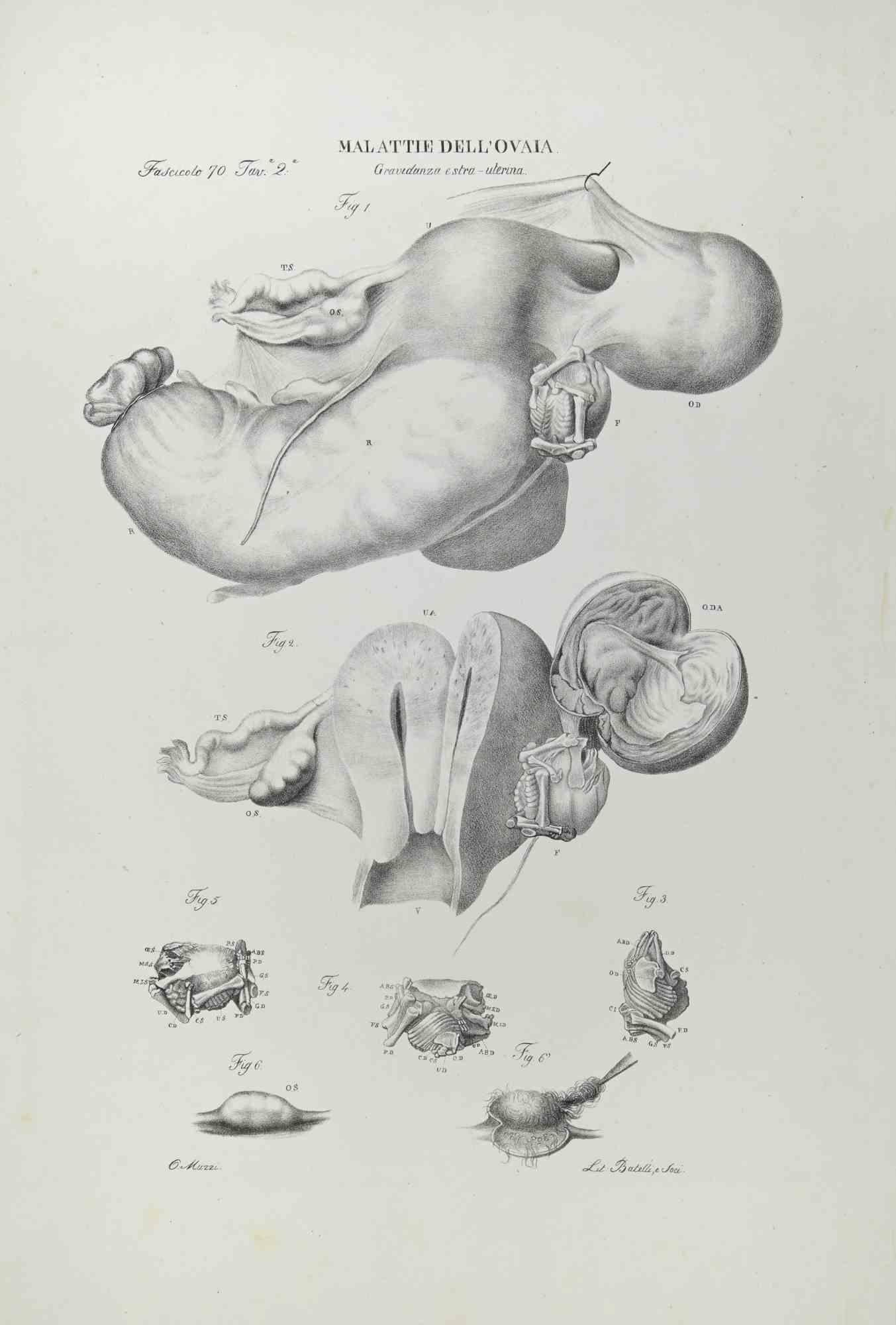 Malattie ovariche è una litografia realizzata da Ottavio Muzzi per l'edizione di Antoine Chazal, Anatomia umana, Stamperia Batelli e Ridolfi, 1843.

L'opera appartiene all'Atlante generale della anatomia patologica del corpo umano di Jean
