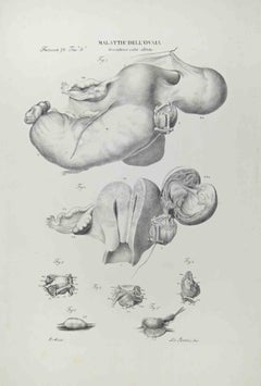 Ovarian Diseases - Lithograph By Ottavio Muzzi - 1843