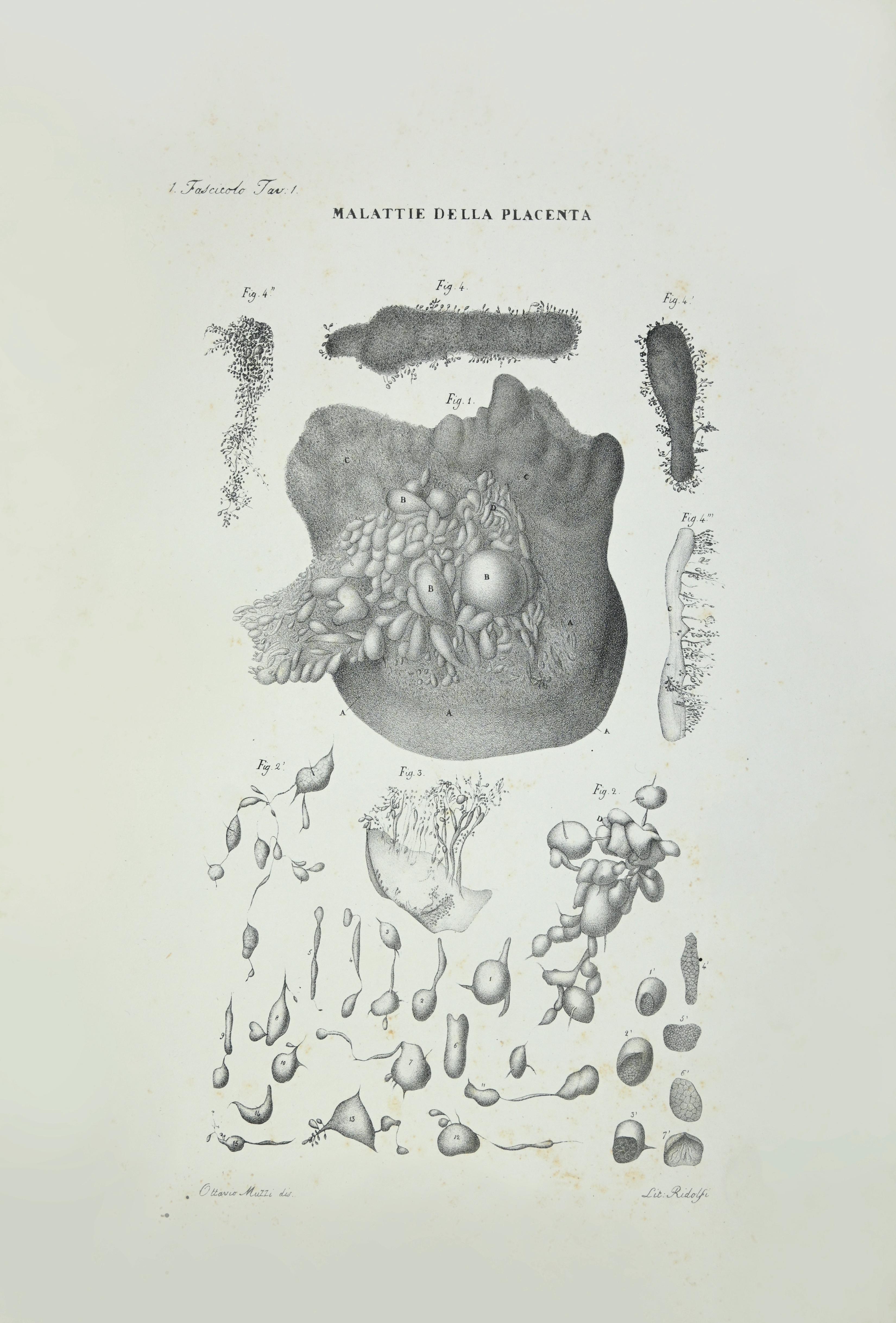 Liver Diseases is a lithograph hand colored by Ottavio Muzzi for the edition of Antoine Chazal, Human Anatomy, Printers Batelli and Ridolfi, realized in 1843.

Signed on plate on the left corner.

The artwork belongs to the "Atlante Generale della