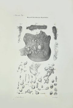 Placenta Diseases - Lithograph By Ottavio Muzzi - 1843
