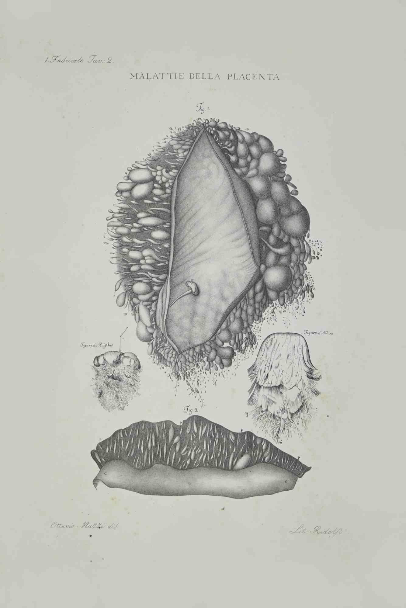 Placenta Diseases is a lithograph hand colored by Ottavio Muzzi for the edition of Antoine Chazal, Human Anatomy, Printers Batelli and Ridolfi, realized in 1843.

Signed on plate on the left corner.

The artwork belongs to the "Atlante Generale