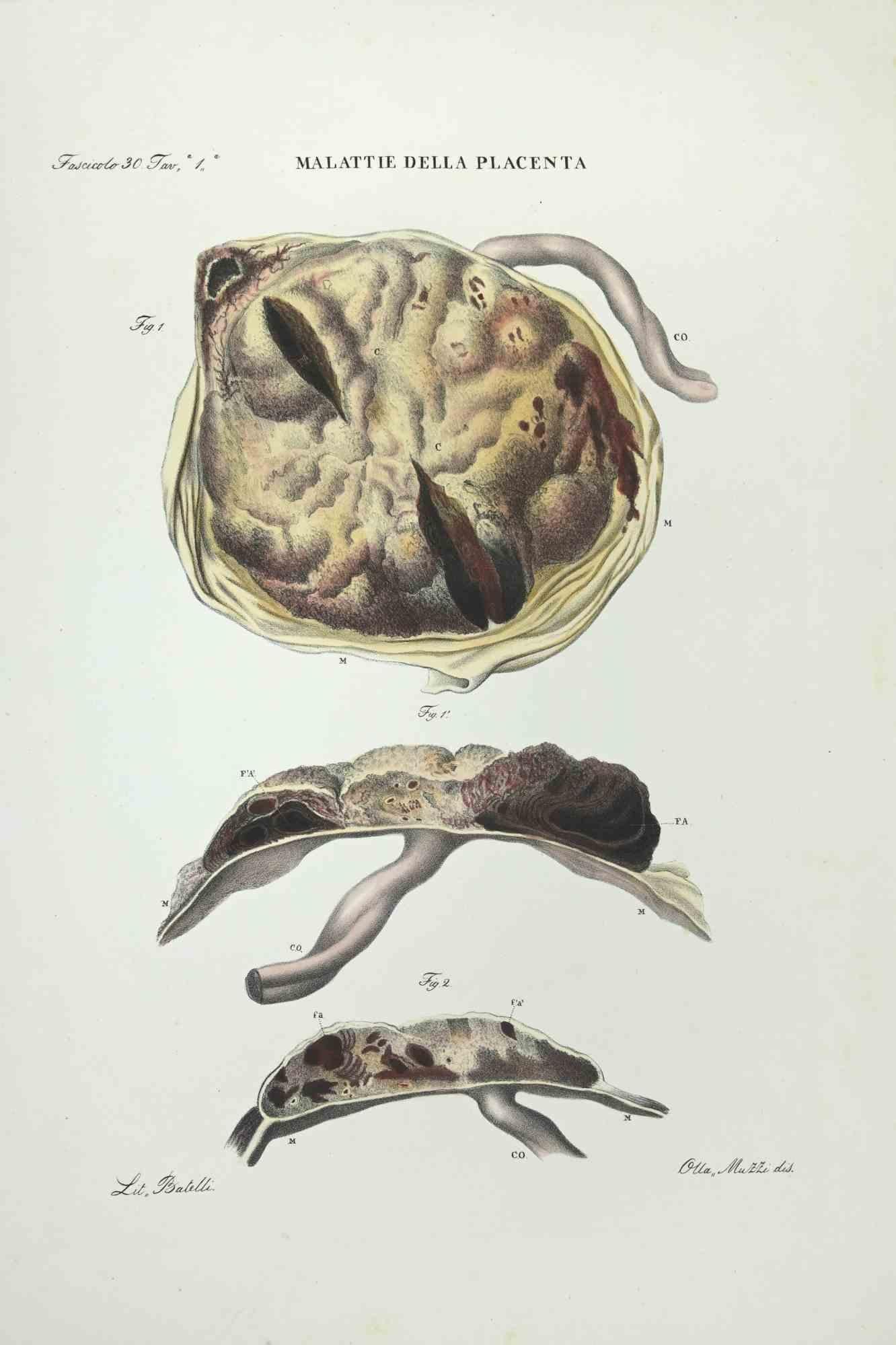 Placenta Diseases is a lithograph hand colored by Ottavio Muzzi for the edition of Antoine Chazal,Human Anatomy, Printers Batelli and Ridolfi, realized in 1843.

Signed on plate on the lower left margin.