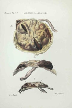 Placenta-Krankheiten – Lithographie von Ottavio Muzzi – 1843
