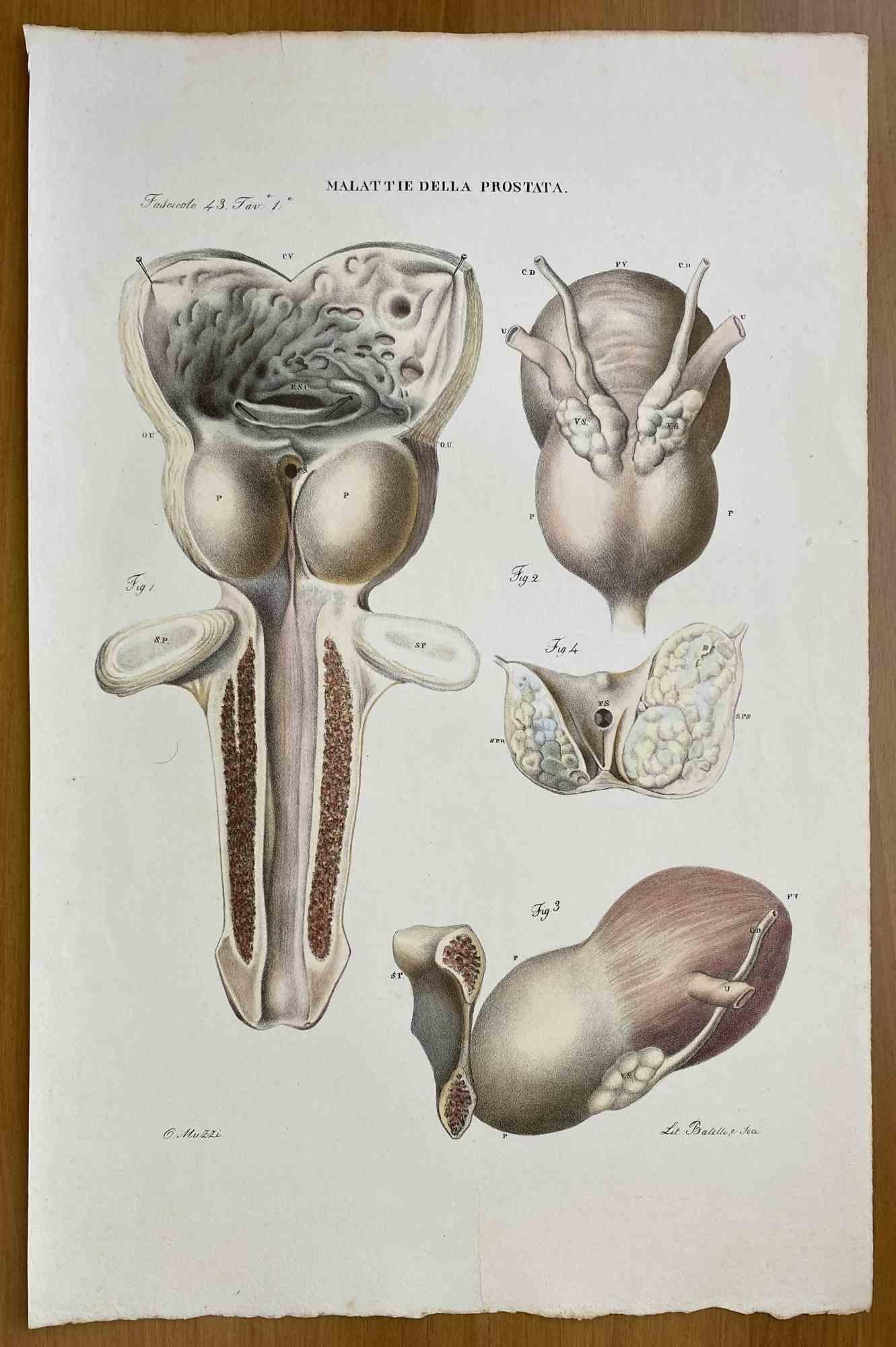 Lithographie « Prostate Diseases » d'Ottavio Muzzi, 1843