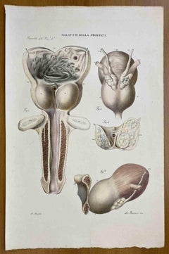  Prostate Diseases - Lithograph By Ottavio Muzzi - 1843