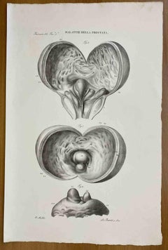 Prostate Krankheiten – Lithographie von Ottavio Muzzi – 1843