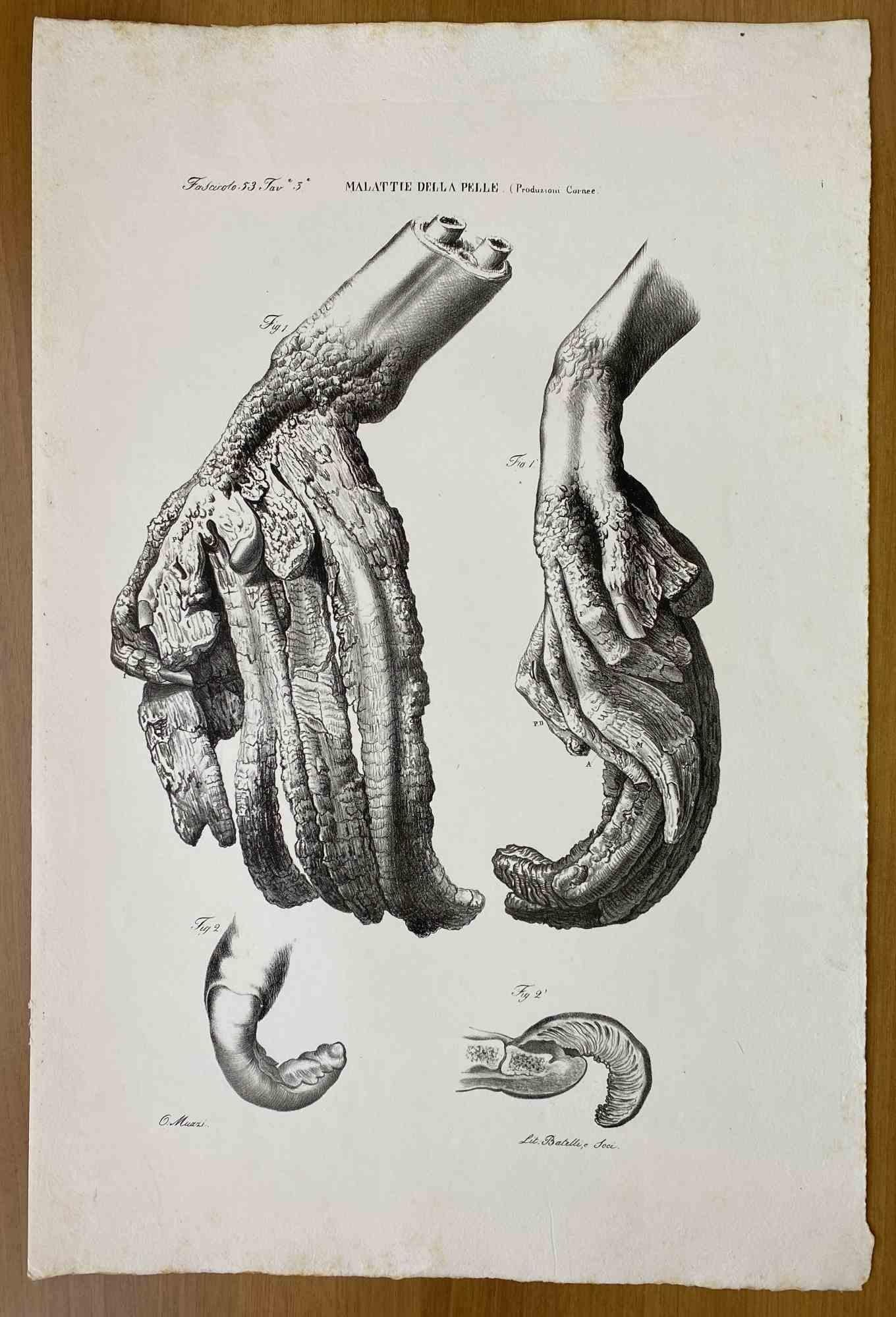 Skin Diseases – Lithographie von Ottavio Muzzi – 1843
