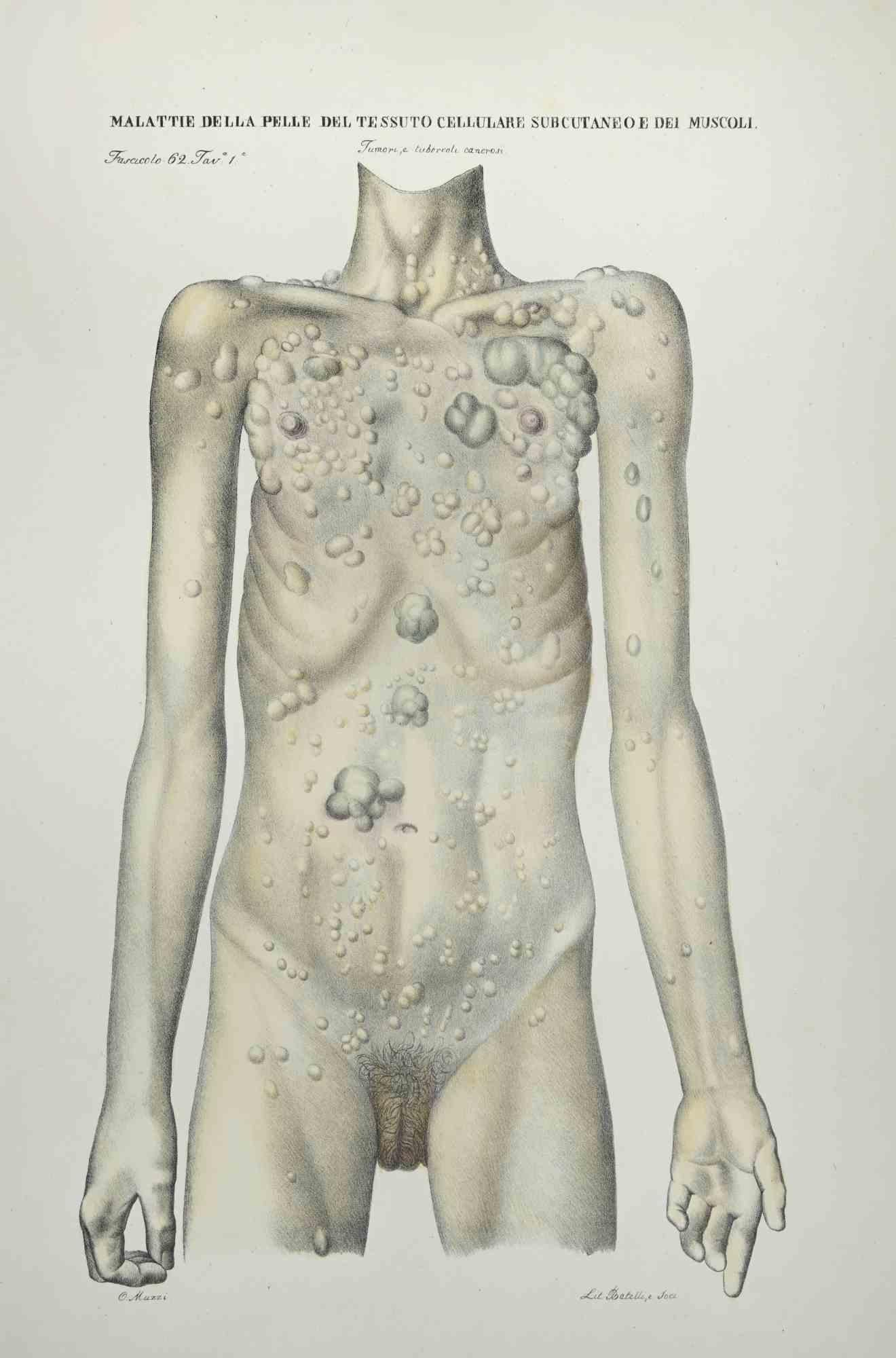 Ottavio Muzzi Figurative Print - Skin Diseases of Subcutaneous Cell Tissue and Muscles-Lithograph By O.Muzzi-1843