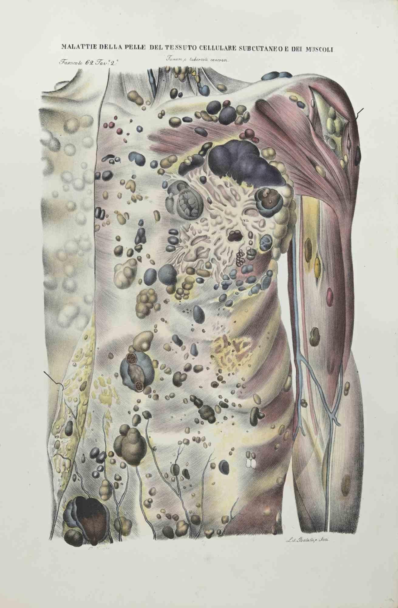 Les maladies de la peau des cellules subcutanées et des moules - Lithographie d'O.Muzzi-1843