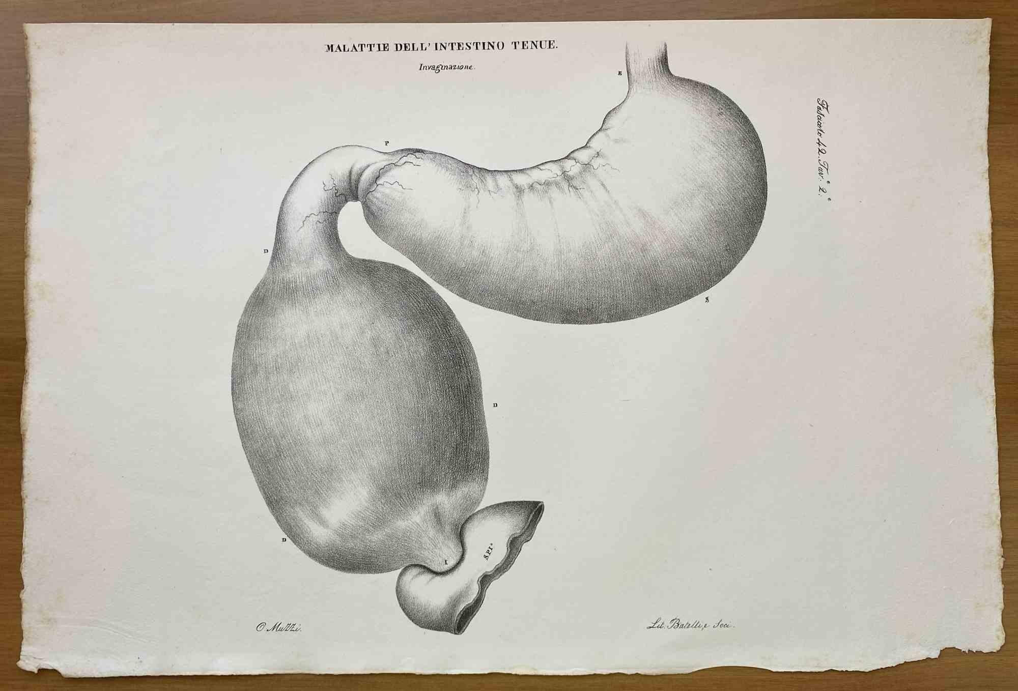 Small Intestine Disease is a lithograph hand colored by Ottavio Muzzi for the edition of Antoine Chazal, Human Anatomy, Printers Batelli and Ridolfi, 1843.

The work belongs to the Atlante generale della anatomia patologica del corpo umano by Jean