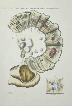 Small Intestine Diseases  - Lithograph By Ottavio Muzzi - 1843