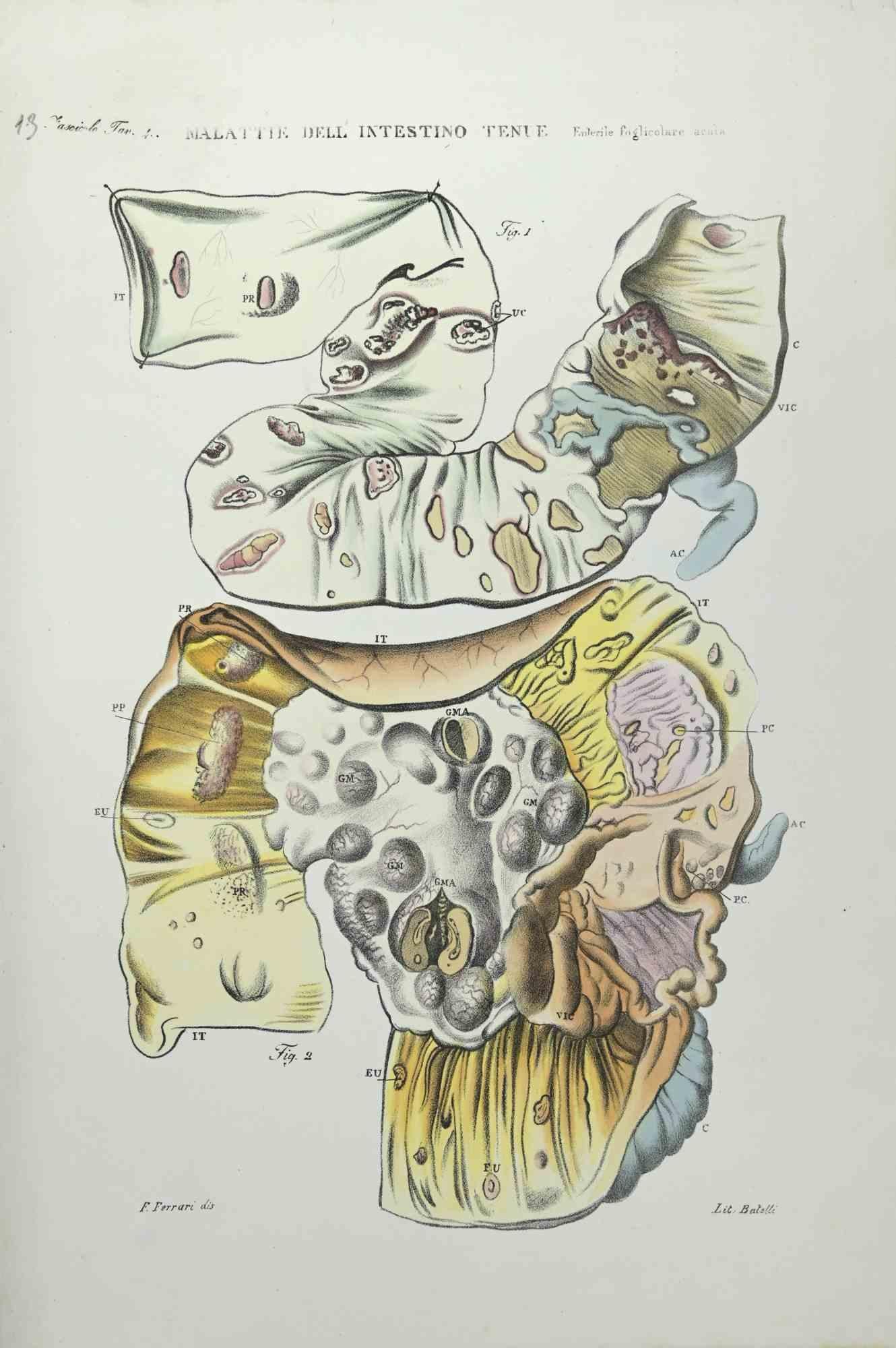 Small Intestine Diseases ist eine handkolorierte Lithographie von Ottavio Muzzi für die Ausgabe von Antoine Chazal, Human Anatomy, Printers Batelli and Ridolfi, aus dem Jahr 1843.

Das Kunstwerk gehört zum "Atlante Generale della Anatomia Patologica