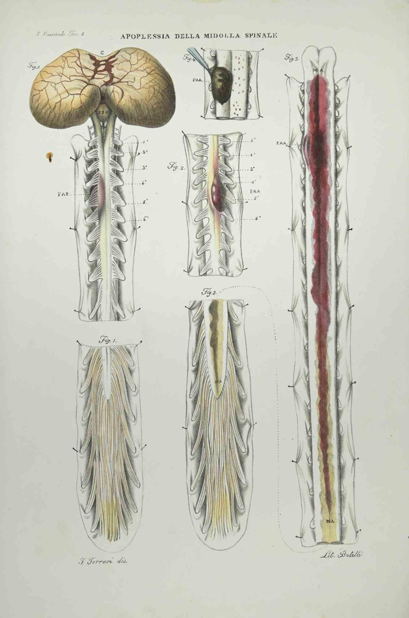 Liver Diseases is a lithograph hand colored by Ottavio Muzzi for the edition of Antoine Chazal, Human Anatomy, Printers Batelli and Ridolfi, 1843.

The work belongs to the Atlante generale della anatomia patologica del corpo umano by Jean