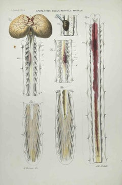 Spinal Cord Apoplexy - Lithograph By Ottavio Muzzi - 1843