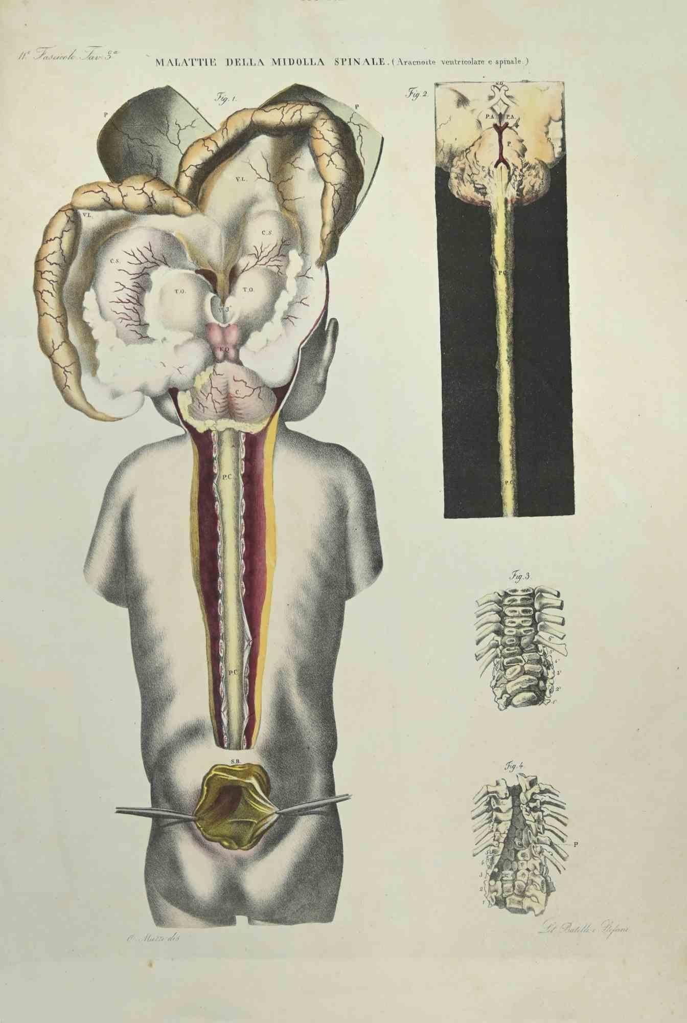 Spinal Cord Diseases is a lithograph hand colored by Ottavio Muzzi for the edition of Antoine Chazal, Human Anatomy, Printers Batelli and Ridolfi, 1843.

The work belongs to the Atlante generale della anatomia patologica del corpo umano by Jean