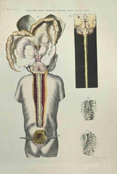 Spinal Cord Diseases - Lithograph By Ottavio Muzzi - 1843