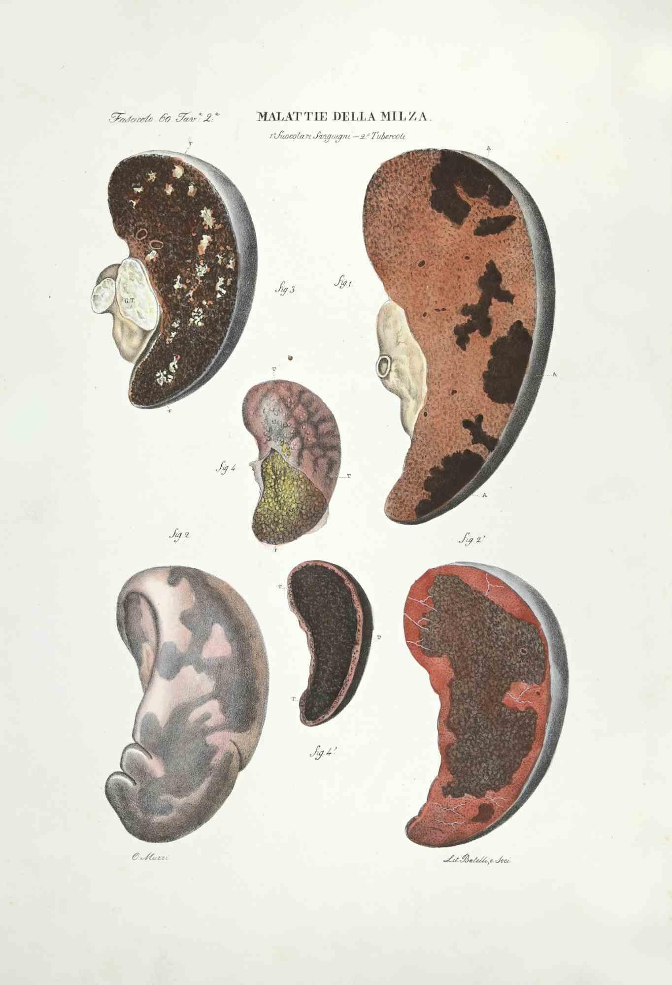 Spleen Diseases is a lithograph hand colored by Ottavio Muzzi for the edition of Antoine Chazal,Human Anatomy, Printers Batelli and Ridolfi, realized in 1843.

Signed on plate on the lower left margin.

The artwork belongs to the "Atlante Generale
